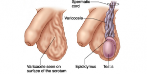 upungufu wa mbegu za kiume varicocele