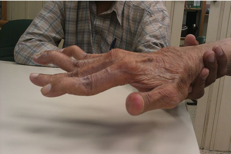 a rheumatoid arthritis 2 ujjának kalapácsváltása)