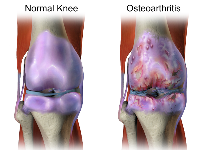 osteoarthritis goti