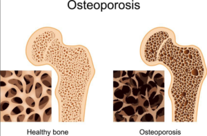osteoporosis ujazo wa mifupa