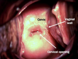 chlamydia cervical