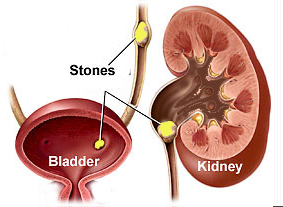 kidney stones sehemu athirika