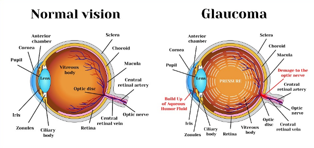 aina za glaucoma