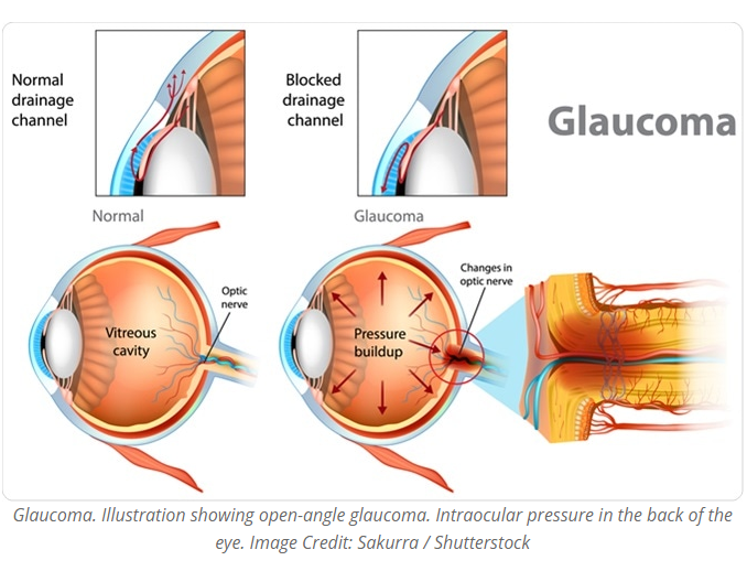 sababu za glaucoma