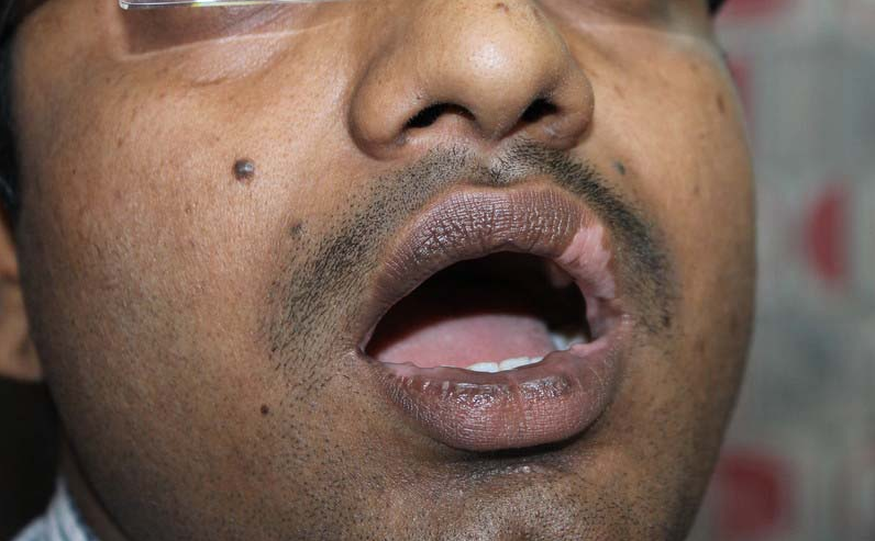 vitiligo mdomoni