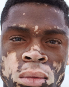 vitiligo usoni